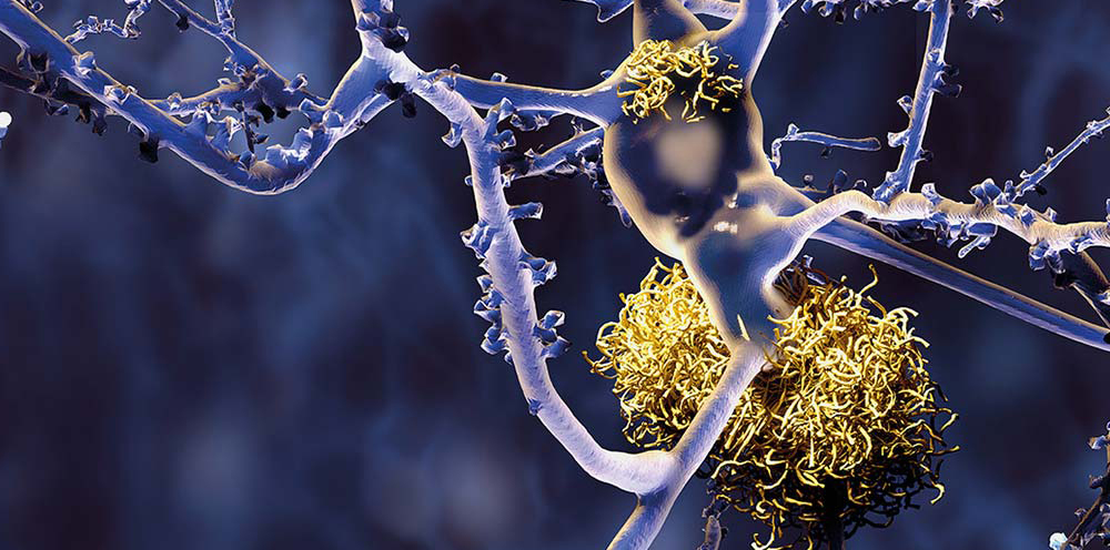 Detektion von Alzheimer-Blutmarkern